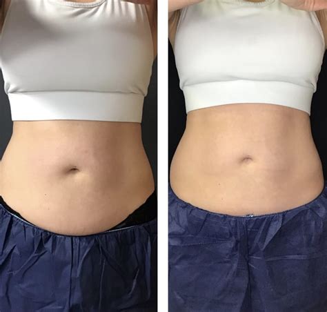 Body Contouring .